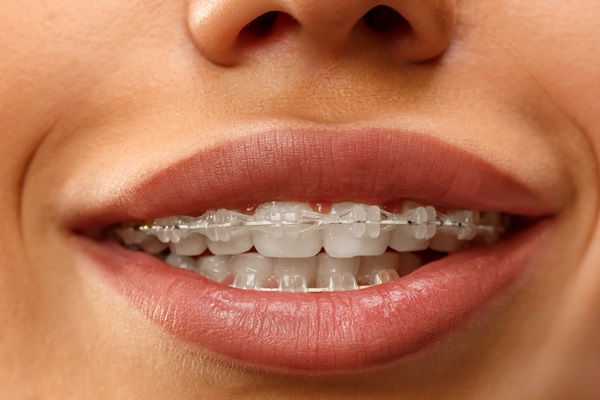 Why Clear Braces For Teens Are Recommended