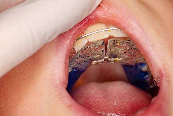 Orthodontic Expanders: Commonly Asked Questions