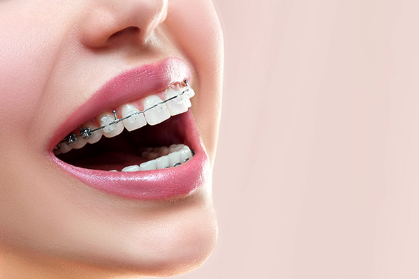 The Steps Of Getting Metal Braces